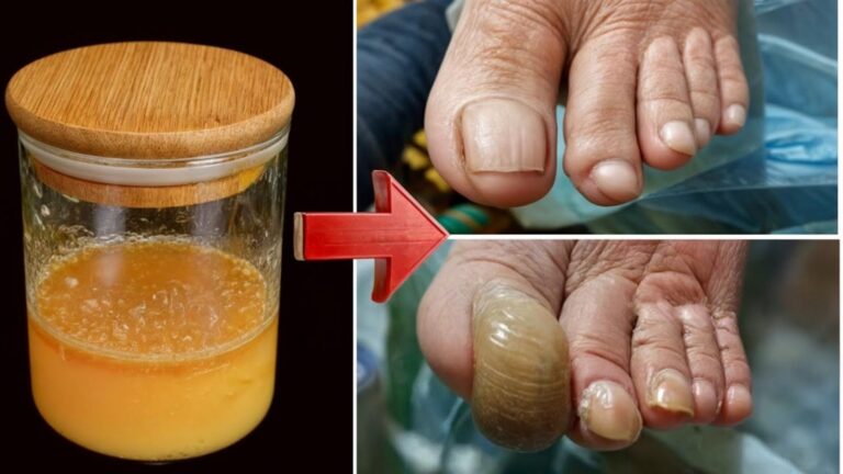 Un vecchio trucco per eliminare il fungo delle unghie: risultati sorprendenti in pochi
