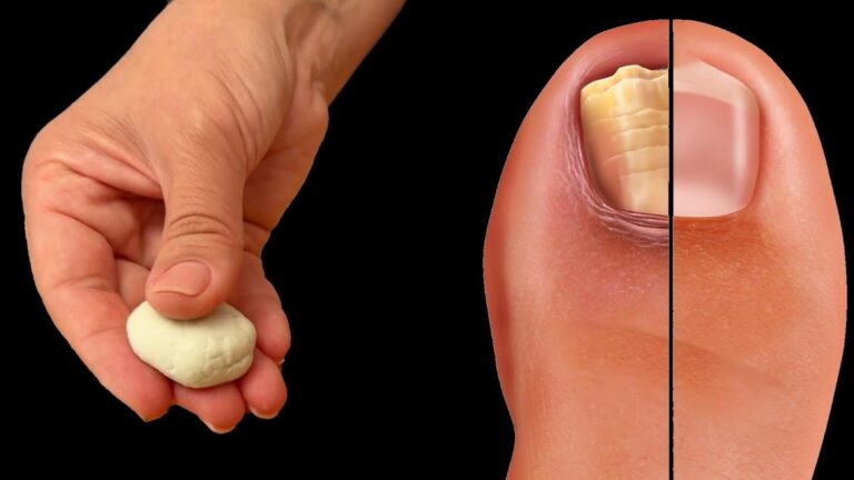 Questo metodo naturale fa sparire il fungo delle unghie… scopri come applicarlo